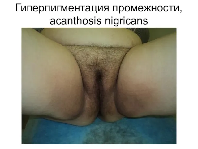 Гиперпигментация промежности, acanthosis nigricans