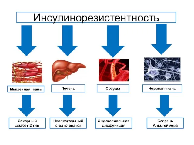 Инсулинорезистентность Мышечная ткань Печень Сосуды Нервная ткань Сахарный диабет 2 тип Неалкогольный