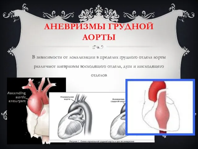 АНЕВРИЗМЫ ГРУДНОЙ АОРТЫ В зависимости от локализации в пределах грудного отдела аорты