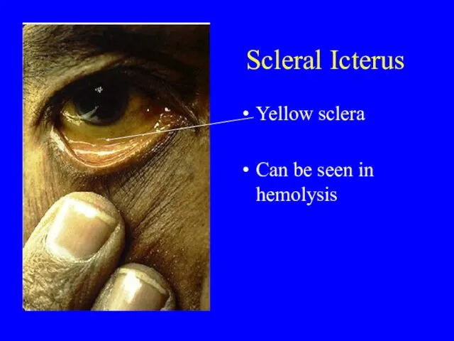Scleral Icterus Yellow sclera Can be seen in hemolysis