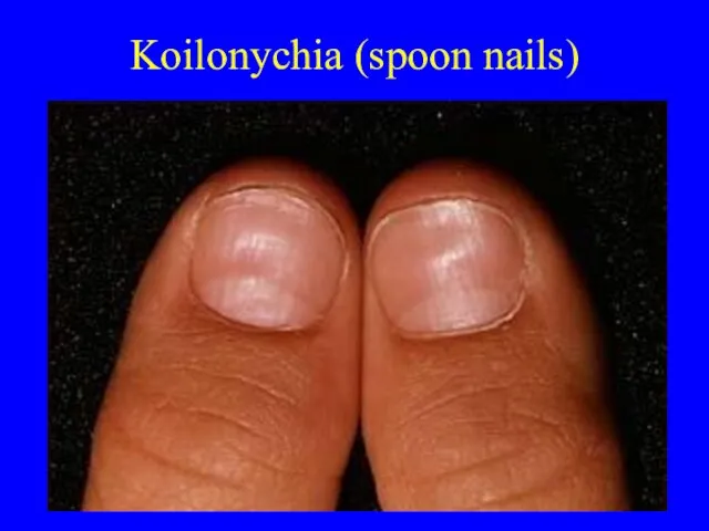 Koilonychia (spoon nails)
