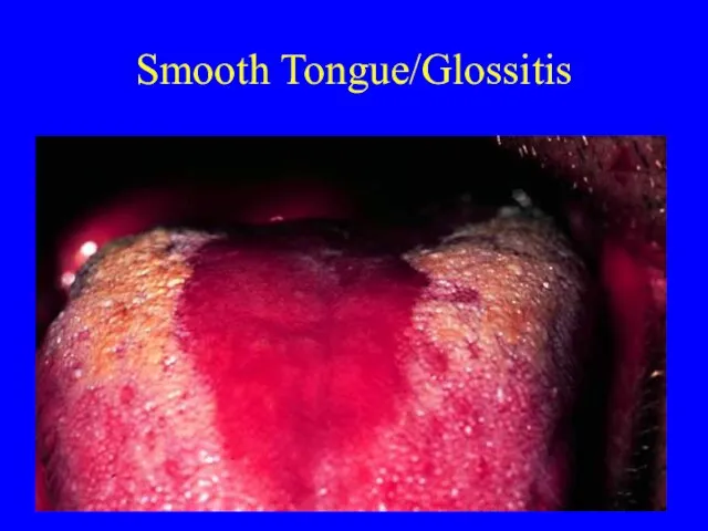 Smooth Tongue/Glossitis