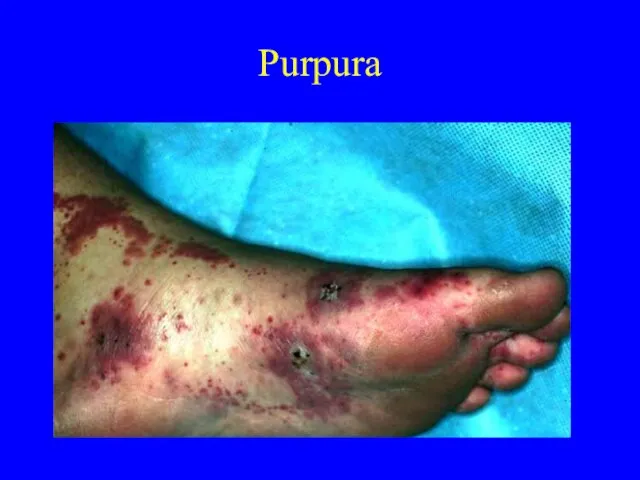 Purpura