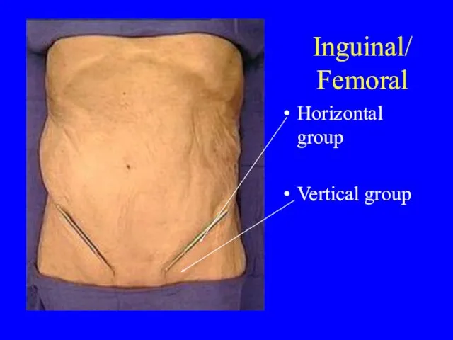 Inguinal/ Femoral Horizontal group Vertical group