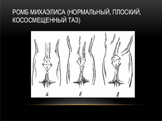 РОМБ МИХАЭЛИСА (НОРМАЛЬНЫЙ, ПЛОСКИЙ, КОСОСМЕЩЕННЫЙ ТАЗ)