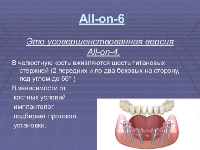 All-on-6 Это усовершенствованная версия All-on-4. В челюстную кость вживляются шесть титановых стержней