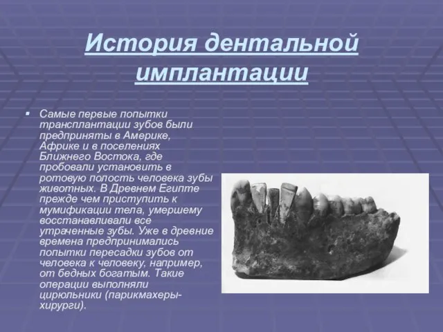 История дентальной имплантации Самые первые попытки трансплантации зубов были предприняты в Америке,