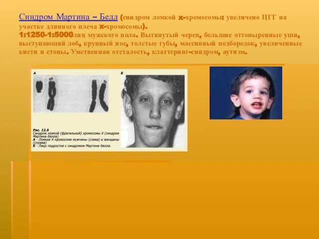 Синдром Мартина – Белл (синдром ломкой x-хромосомы: увеличено ЦГГ на участке длинного