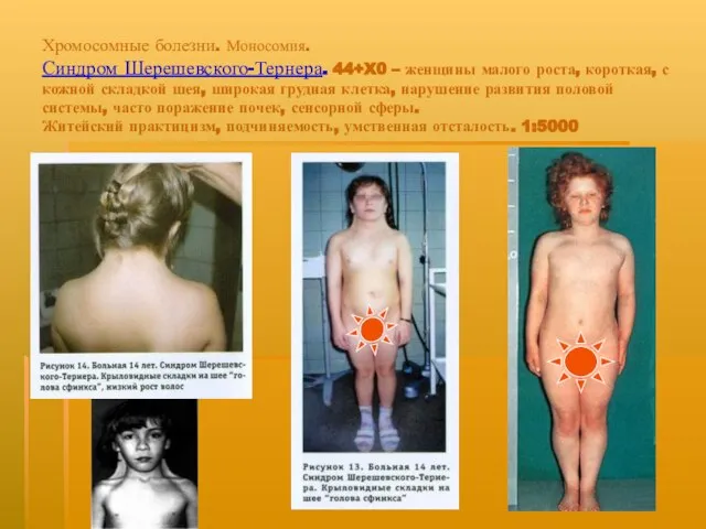 Хромосомные болезни. Моносомия. Синдром Шерешевского-Тернера. 44+X0 – женщины малого роста, короткая, с