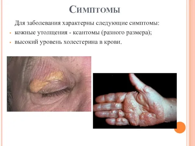 Симптомы Для заболевания характерны следующие симптомы: кожные утолщения - ксантомы (разного размера);