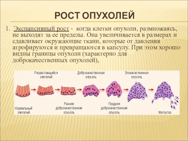 РОСТ ОПУХОЛЕЙ 1. Экспансивный рост - когда клетки опухоли, размножаясь, не выходят