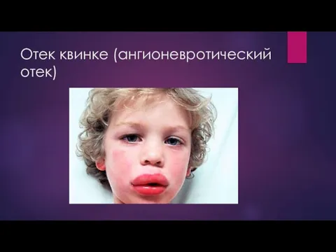 Отек квинке (ангионевротический отек)