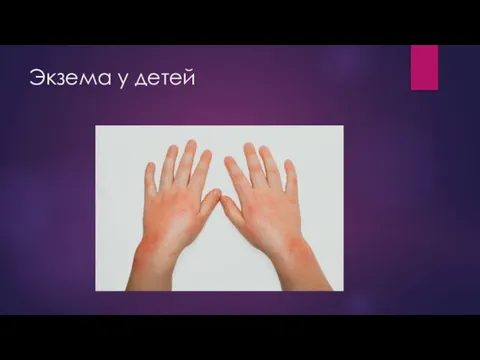 Экзема у детей