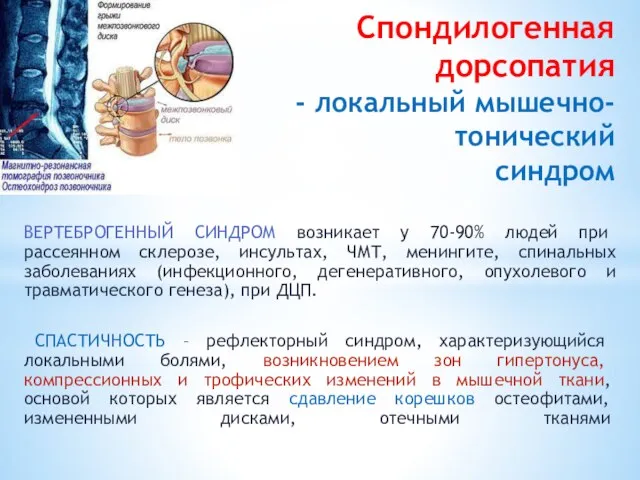 Спондилогенная дорсопатия - локальный мышечно-тонический син­дром ВЕРТЕБРОГЕННЫЙ СИНДРОМ возникает у 70-90% людей