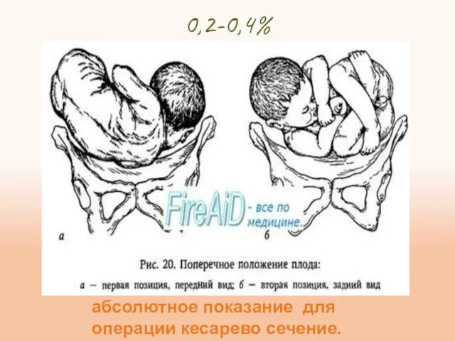 0,2-0,4% абсолютное показание для операции кесарево сечение.