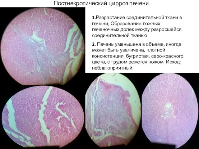 Постнекротический цирроз печени. 1.Разрастание соединительной ткани в печени; Образование ложных печеночных долек