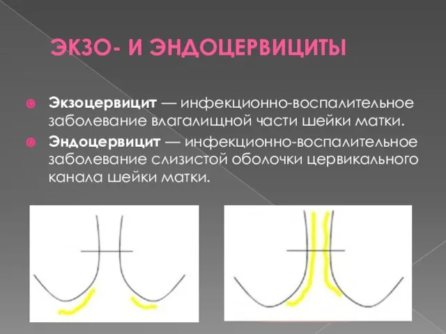 ЭКЗО- И ЭНДОЦЕРВИЦИТЫ Экзоцервицит — инфекционно-воспалительное заболевание влагалищной части шейки матки. Эндоцервицит