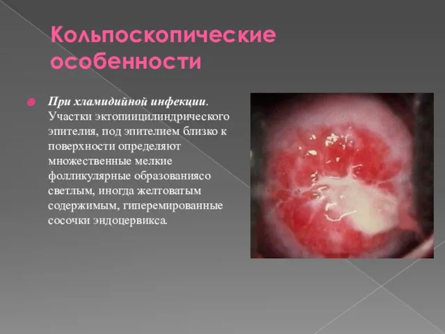 Кольпоскопические особенности При хламидийной инфекции. Участки эктопиицилиндрического эпителия, под эпителием близко к