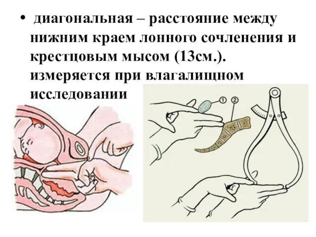 диагональная – расстояние между нижним краем лонного сочленения и крестцовым мысом (13см.). измеряется при влагалищном исследовании