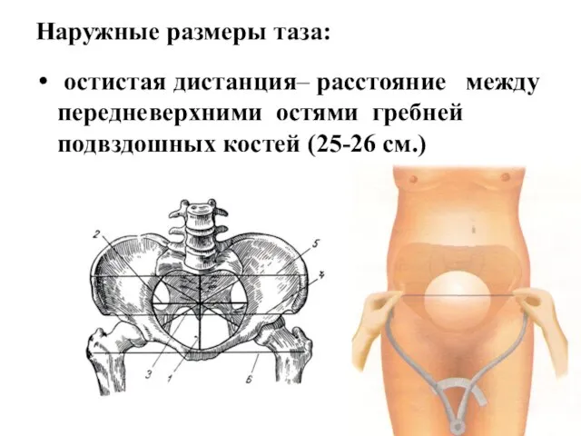 Наружные размеры таза: остистая дистанция– расстояние между передневерхними остями гребней подвздошных костей (25-26 см.)