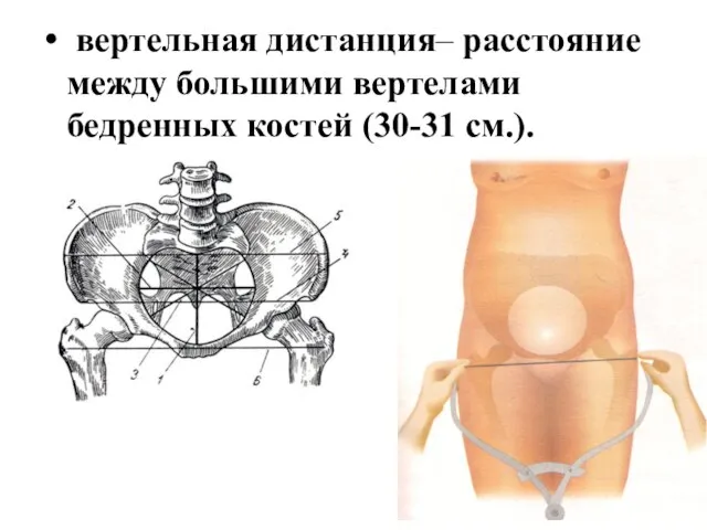 вертельная дистанция– расстояние между большими вертелами бедренных костей (30-31 см.).