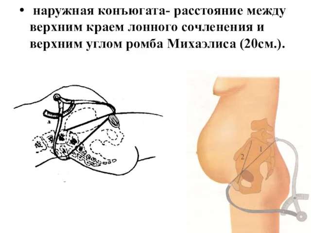 наружная конъюгата- расстояние между верхним краем лонного сочленения и верхним углом ромба Михаэлиса (20см.).