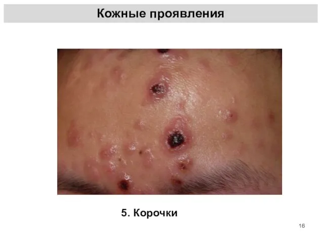 Кожные проявления 5. Корочки