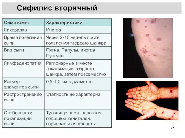 Сифилис вторичный