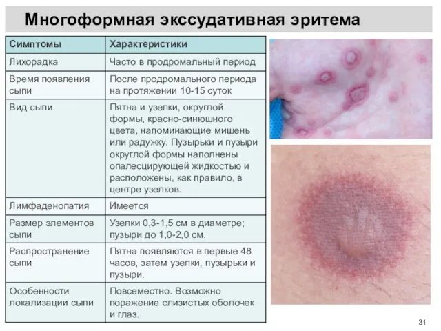 Многоформная экссудативная эритема