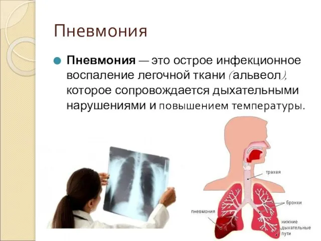 Пневмония Пневмония — это острое инфекционное воспаление легочной ткани (альвеол), которое сопровождается