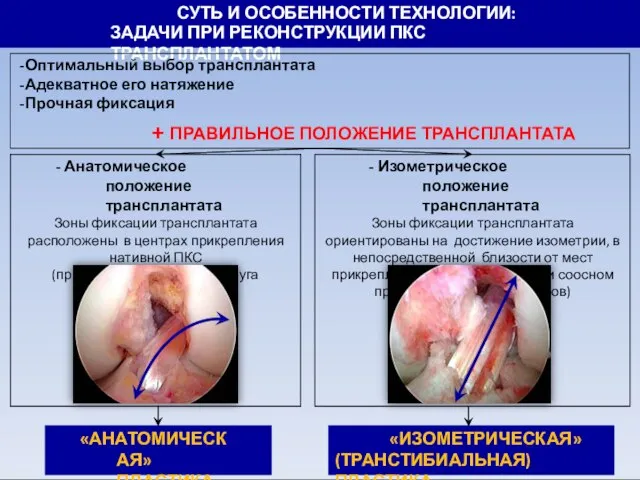 СУТЬ И ОСОБЕННОСТИ ТЕХНОЛОГИИ: ЗАДАЧИ ПРИ РЕКОНСТРУКЦИИ ПКС ТРАНСПЛАНТАТОМ Оптимальный выбор трансплантата