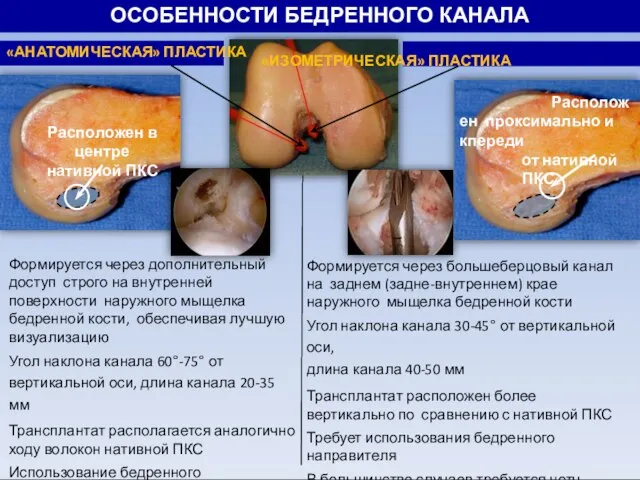 ОСОБЕННОСТИ БЕДРЕННОГО КАНАЛА Формируется через дополнительный доступ строго на внутренней поверхности наружного