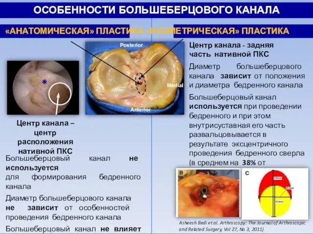 Большеберцовый канал не используется для формирования бедренного канала Диаметр большеберцового канала не