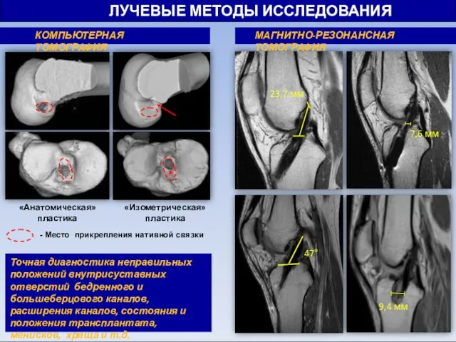 * ЛУЧЕВЫЕ МЕТОДЫ ИССЛЕДОВАНИЯ - Место прикрепления нативной связки Точная диагностика неправильных