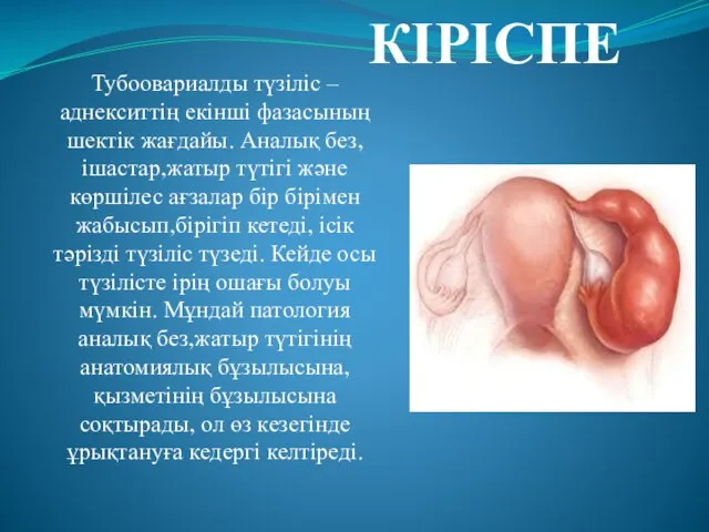 Тубоовариалды түзіліс – аднекситтің екінші фазасының шектік жағдайы. Аналық без, ішастар,жатыр түтігі