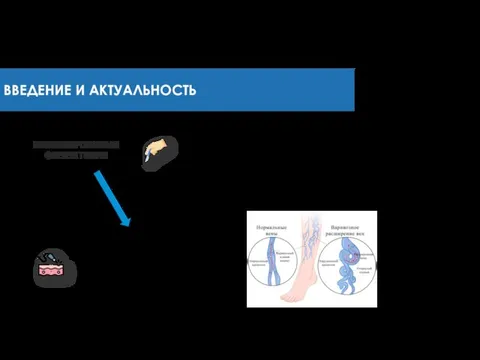 КОМБИНИРОВАННАЯ ФЛЕБЭКТОМИЯ ВВЕДЕНИЕ И АКТУАЛЬНОСТЬ ЭНДОВЕНОЗНАЯ ЛАЗЕРНАЯ ОБЛИТЕРАЦИЯ (ЭВЛО) КРИОСТРИППИНГ ЦЕЛЬ ЛЕЧЕНИЯ