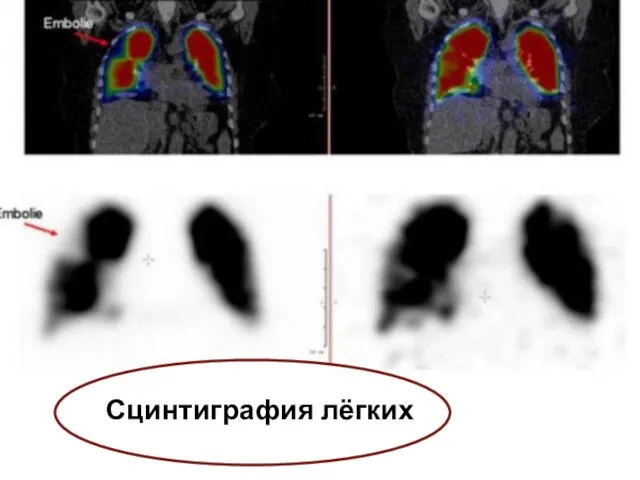 Сцинтиграфия лёгких