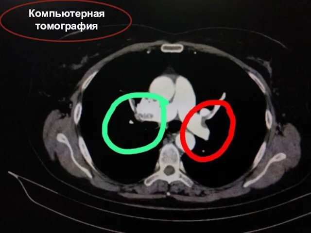 Компьютерная томография