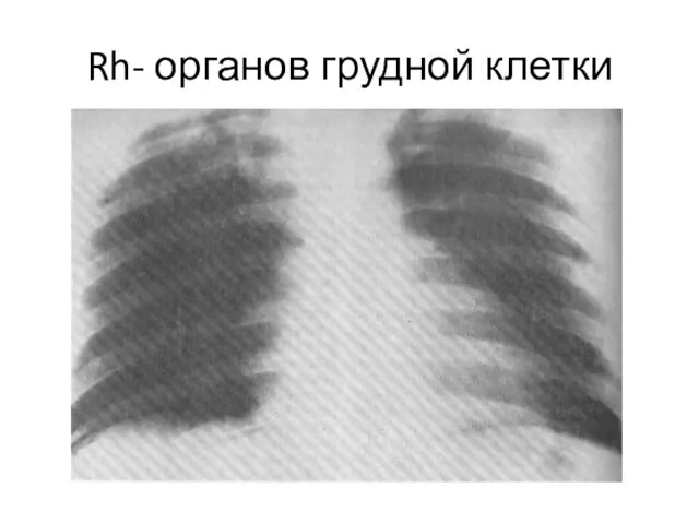 Rh- органов грудной клетки