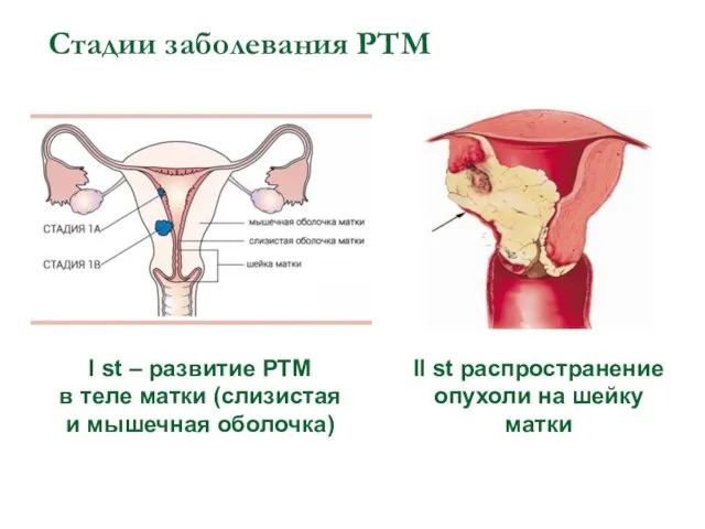 Стадии заболевания РТМ I st – развитие РТМ в теле матки (слизистая