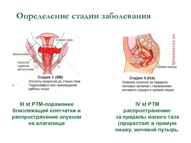 Определение стадии заболевания III st РТМ-поражение близлежащей клетчатки и распространение опухоли на