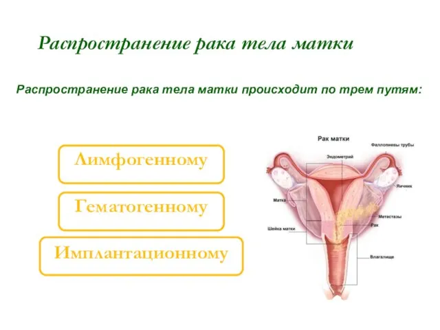 Распространение рака тела матки Распространение рака тела матки происходит по трем путям: Лимфогенному Гематогенному Имплантационному