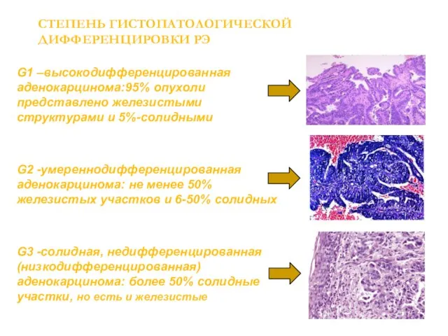 СТЕПЕНЬ ГИСТОПАТОЛОГИЧЕСКОЙ ДИФФЕРЕНЦИРОВКИ РЭ G1 –высокодифференцированная аденокарцинома:95% опухоли представлено железистыми структурами и