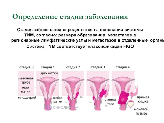 Определение стадии заболевания Стадия заболевания определяется на основании системы TNM, согласно: размера