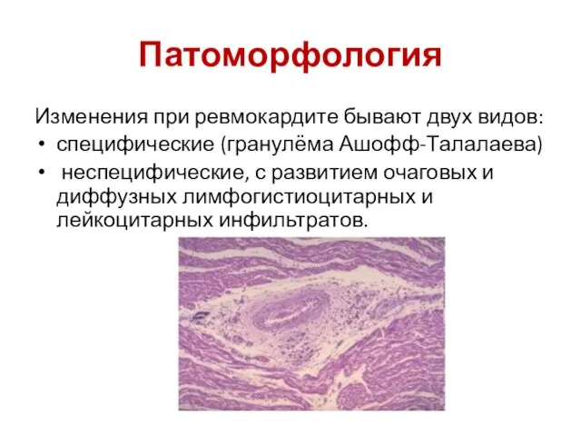 Патоморфология Изменения при ревмокардите бывают двух видов: специфические (гранулёма Ашофф-Талалаева) неспецифические, с