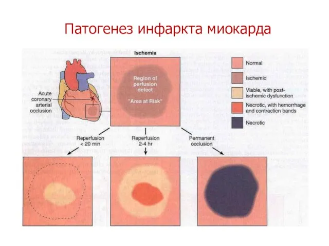 Патогенез инфаркта миокарда