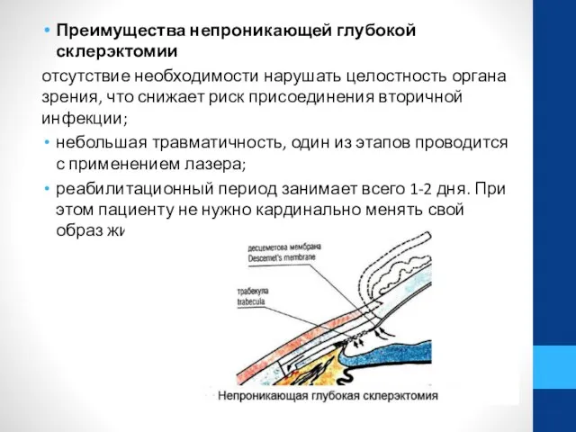 Преимущества непроникающей глубокой склерэктомии отсутствие необходимости нарушать целостность органа зрения, что снижает