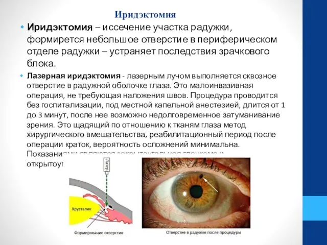 Иридэктомия Иридэктомия – иссечение участка радужки, формирется небольшое отверстие в периферическом отделе