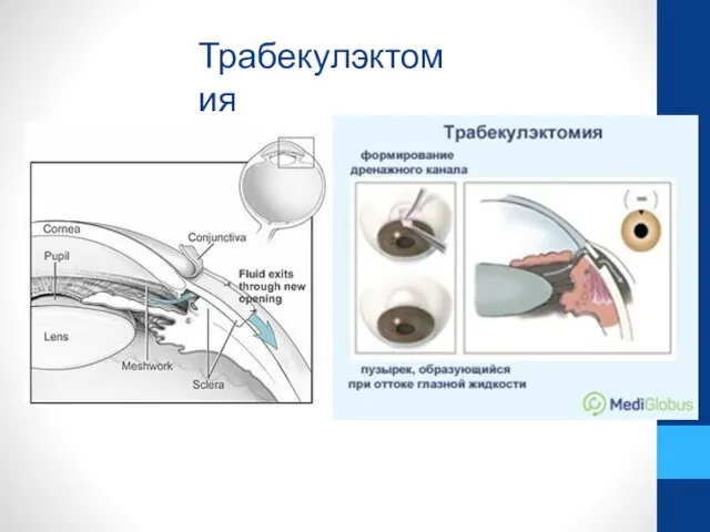 Трабекулэктомия