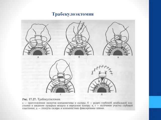 Трабекулоэктомия